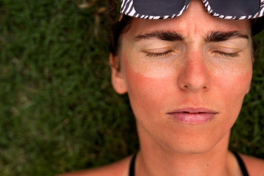 The Ultimate Guide To Understanding, Treating & Preventing Sunburns