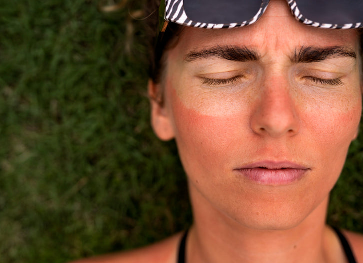 The Ultimate Guide To Understanding, Treating & Preventing Sunburns